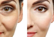 4 Incredible Advantages Of Getting Anti-Wrinkle Injections